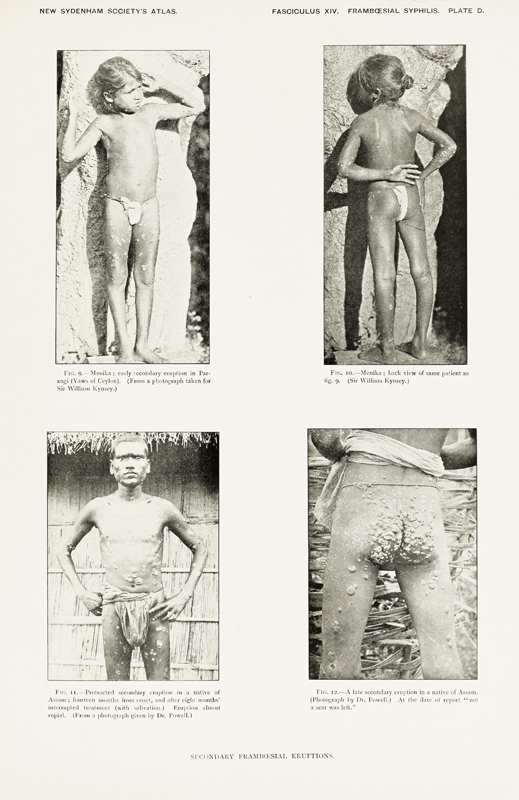 Alt-text: Photographs of boy with sores Alt-text: Photographs of boy with sores