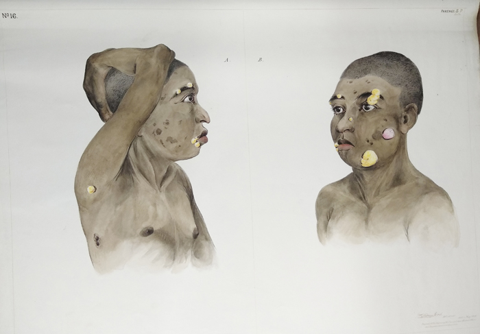 Alt-text: Watercolor drawing of sick child Alt-text: Watercolor drawing of sick child