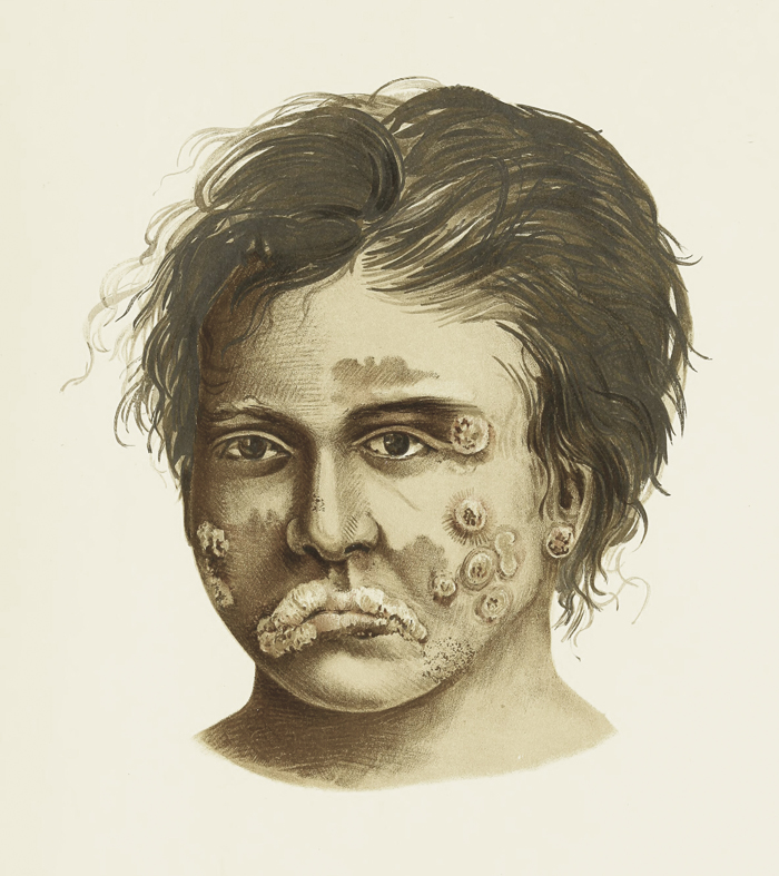 Alt-text: Boy with facial sores Alt-text: Boy with facial sores