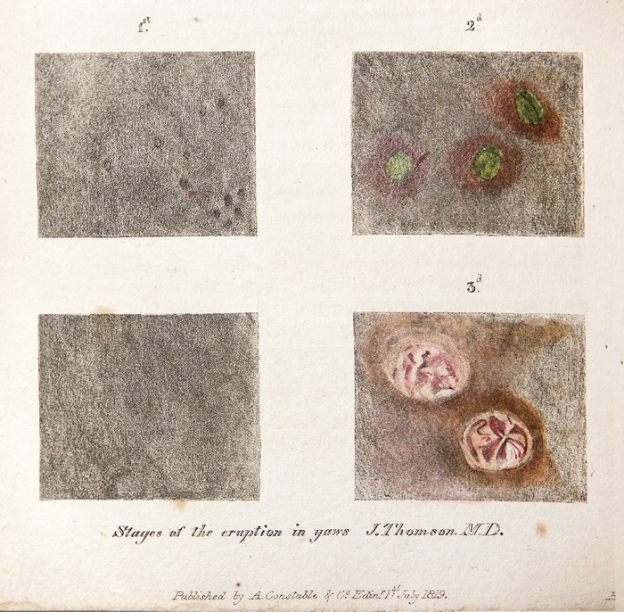 Alt-text: Details of skin sores Alt-text: Details of skin sores