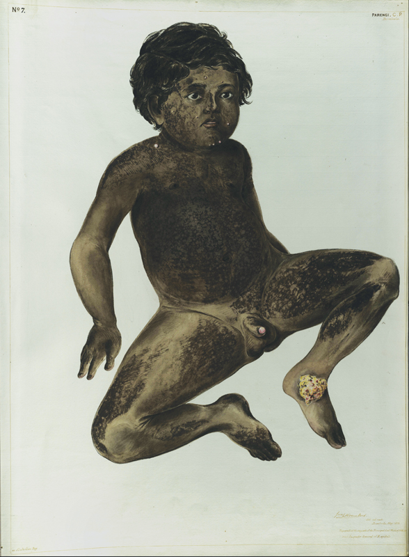 Alt-text: Individual with sores and lesions Alt-text: Individual with sores and lesions