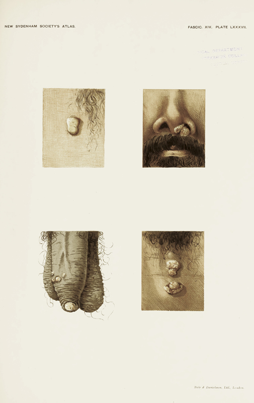 Alt-text: Details of body parts with skin sores Alt-text: Details of body parts with skin sores