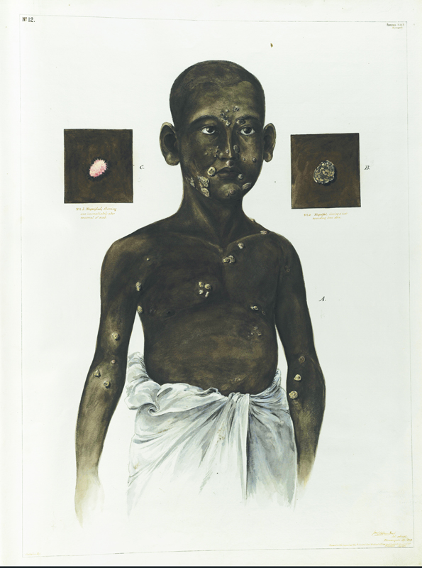 Alt-text: Man with skin sores and lesions Alt-text: Man with skin sores and lesions