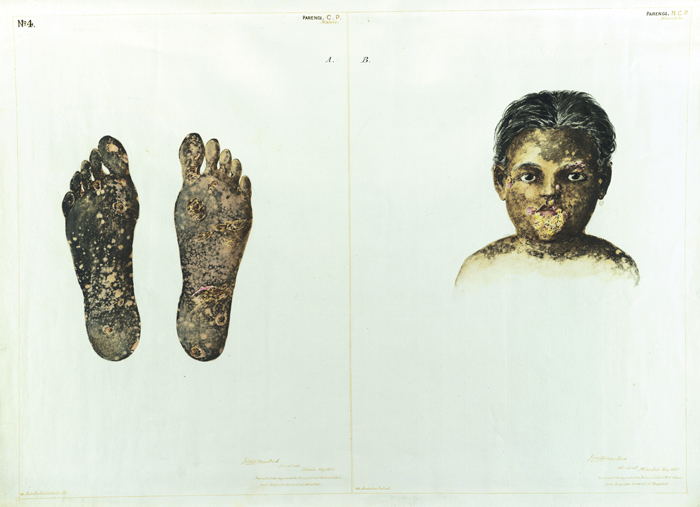 Alt-text: Depictions of skin sores Alt-text: Depictions of skin sores