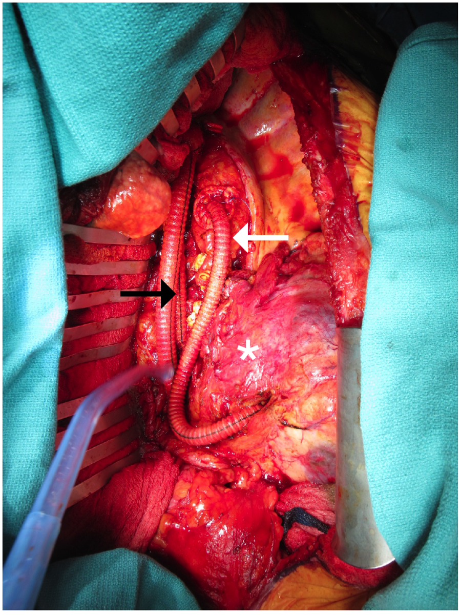 Figure 2.: Intraoperative photograph demonstrating visceral debranching and creation of a thoracic aortic stump. The celiac and superior mesenteric artery graft limbs are located lateral to the aorta. The aorto-renal bypass is clearly visible (white arrow), and the reinforced thoracic aortic stump (black arrow) lies proximal to this bypass. The phlegmon (white asterisk) encases the perivisceral aorta, left renal artery, and left kidney. Figure 2.: Intraoperative photograph demonstrating visceral debranching and creation of a thoracic aortic stump. The celiac and superior mesenteric artery graft limbs are located lateral to the aorta. The aorto-renal bypass is clearly visible (white arrow), and the reinforced thoracic aortic stump (black arrow) lies proximal to this bypass. The phlegmon (white asterisk) encases the perivisceral aorta, left renal artery, and left kidney.