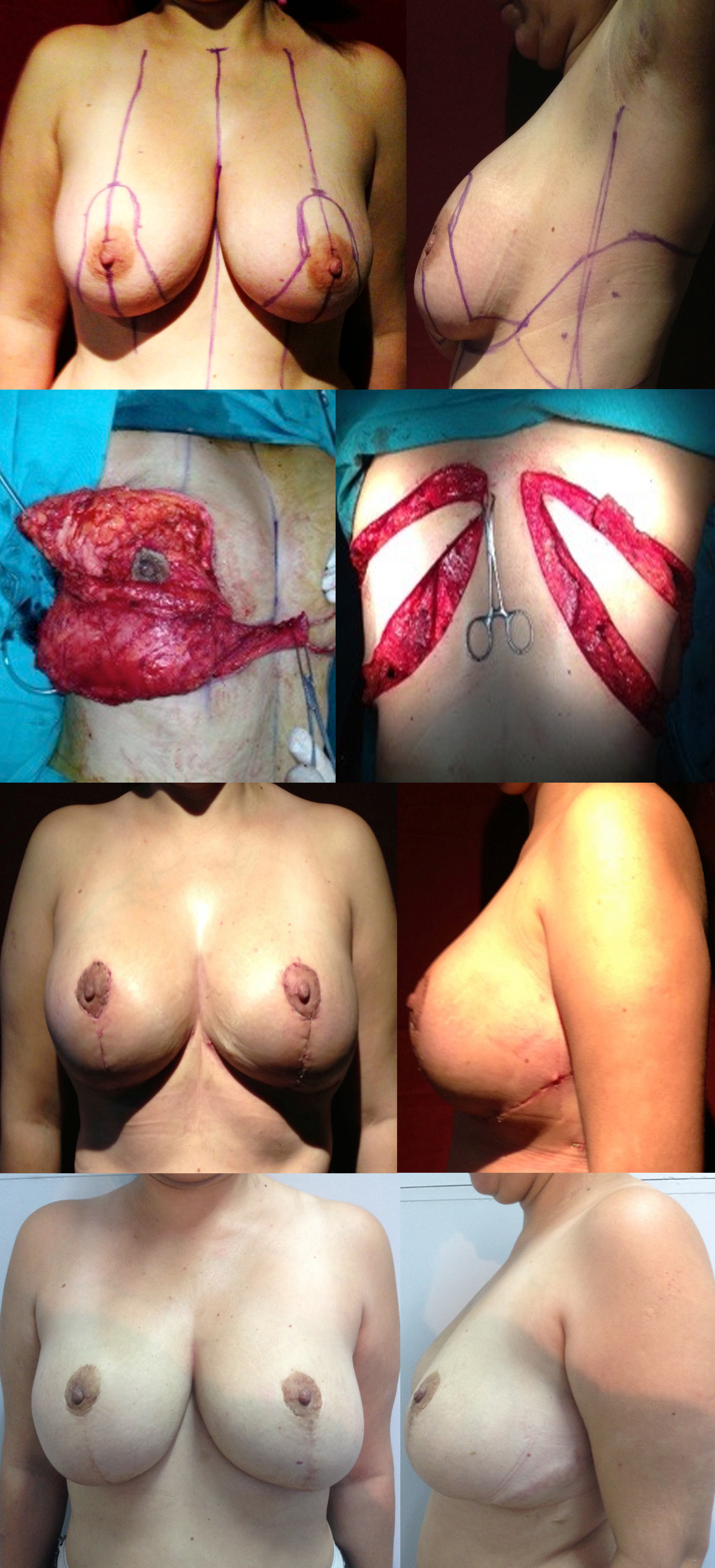 Figure 1.: A 41-year-old woman with bilateral siliconomas underwent simultaneous bilateral de-epithelialized TDAP with an ascending oblique design and turnover technique in the ventral decubitus position by 2 teams operating simultaneously. The patient was transferred to the dorsal decubitus position, and the teams simultaneously performed a bilateral reducing mastectomy with an inverted T-pattern and an inferior pedicle, then inset and reconstructed the flaps. The total operative time was 180 minutes. The patient was completely satisfied (5/5) with the final result and the donor area at 2.5 years postoperatively. Figure 1.: A 41-year-old woman with bilateral siliconomas underwent simultaneous bilateral de-epithelialized TDAP with an ascending oblique design and turnover technique in the ventral decubitus position by 2 teams operating simultaneously. The patient was transferred to the dorsal decubitus position, and the teams simultaneously performed a bilateral reducing mastectomy with an inverted T-pattern and an inferior pedicle, then inset and reconstructed the flaps. The total operative time was 180 minutes. The patient was completely satisfied (5/5) with the final result and the donor area at 2.5 years postoperatively.